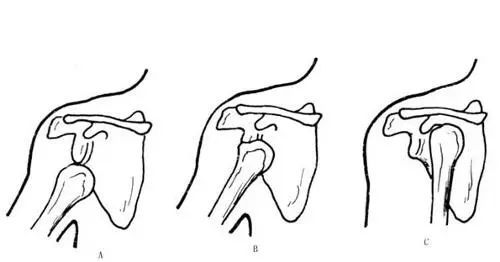 锁骨下脱位喙突下脱位盂下脱位(2)对前脱位的类型需进一步鉴别;肩关节