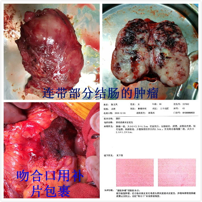 一例胃間質瘤耐藥後復發再手術