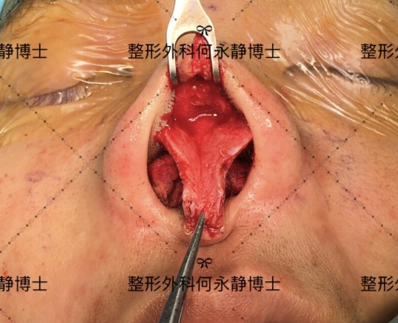 充分游离鼻翼软骨和鼻中隔软骨,显露鼻中隔及分离鼻背筋膜,矫正鼻部