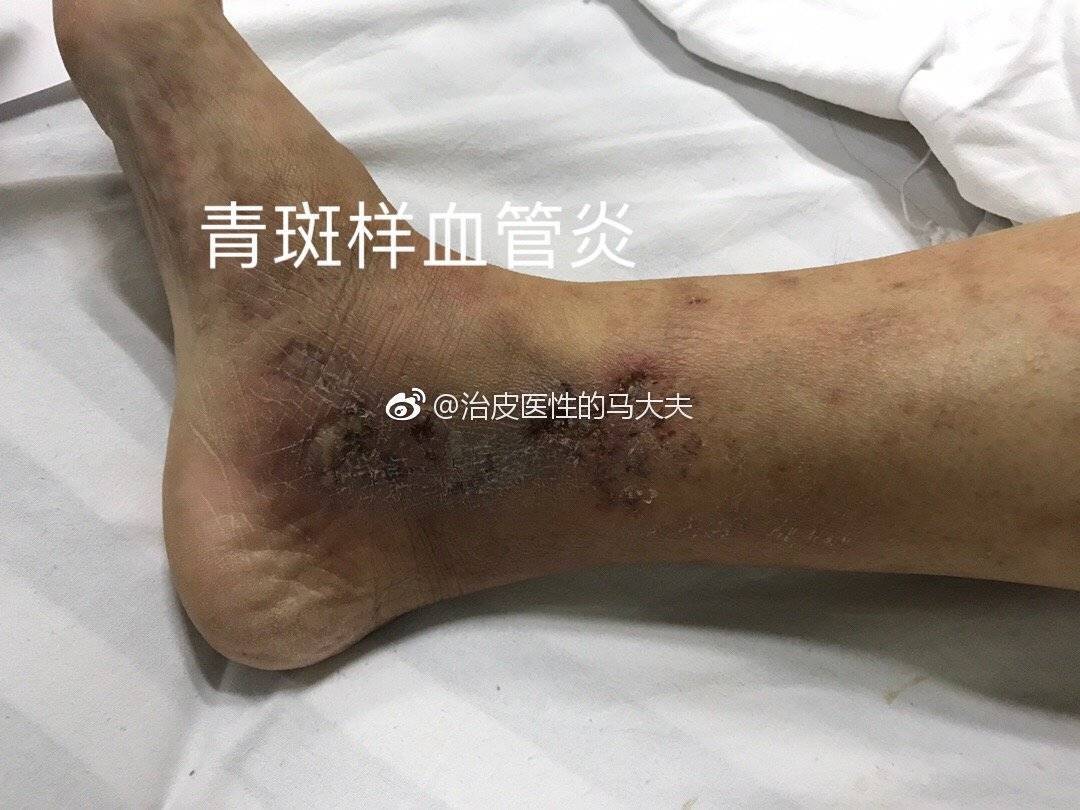 皮肤病图片大全腿部图片