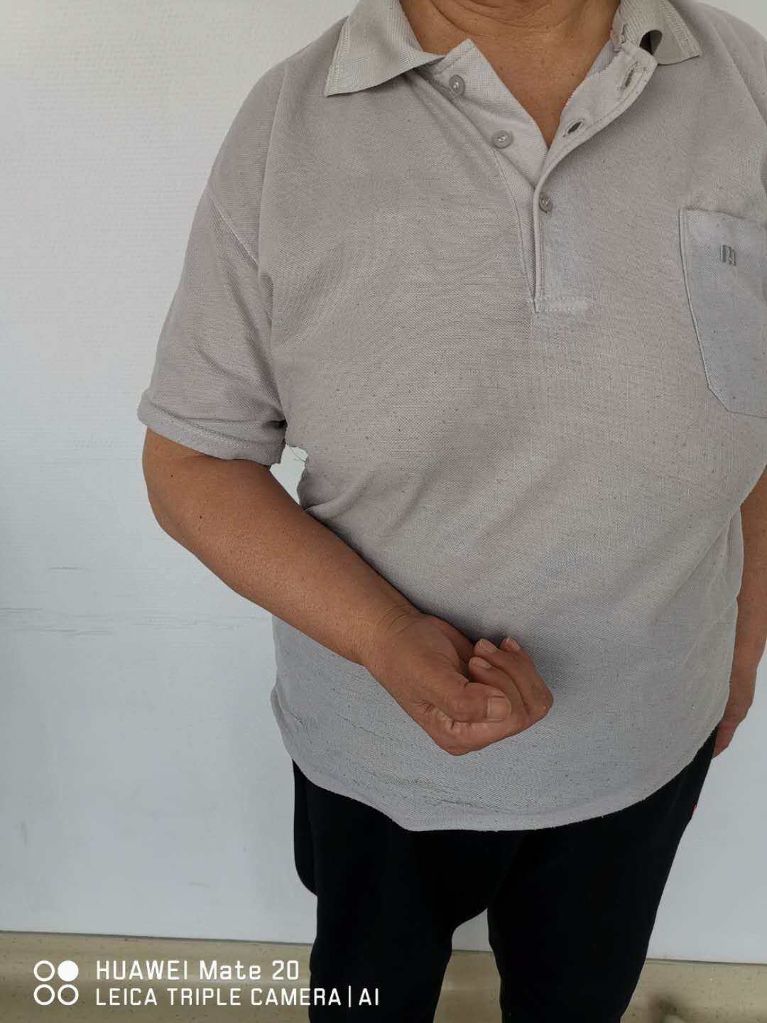 脑中风后遗症～上肢偏瘫的康复新技术