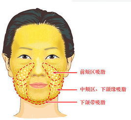 面部吸脂 告别肉肉脸 面部吸脂 告别肉肉脸