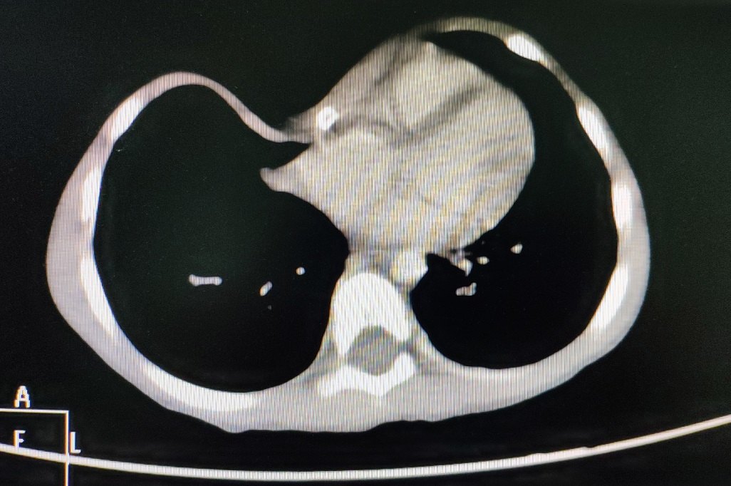 先天性胸壁瘘管图片