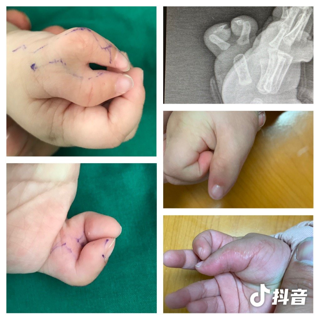手指蟹钳畸形几种类型图片
