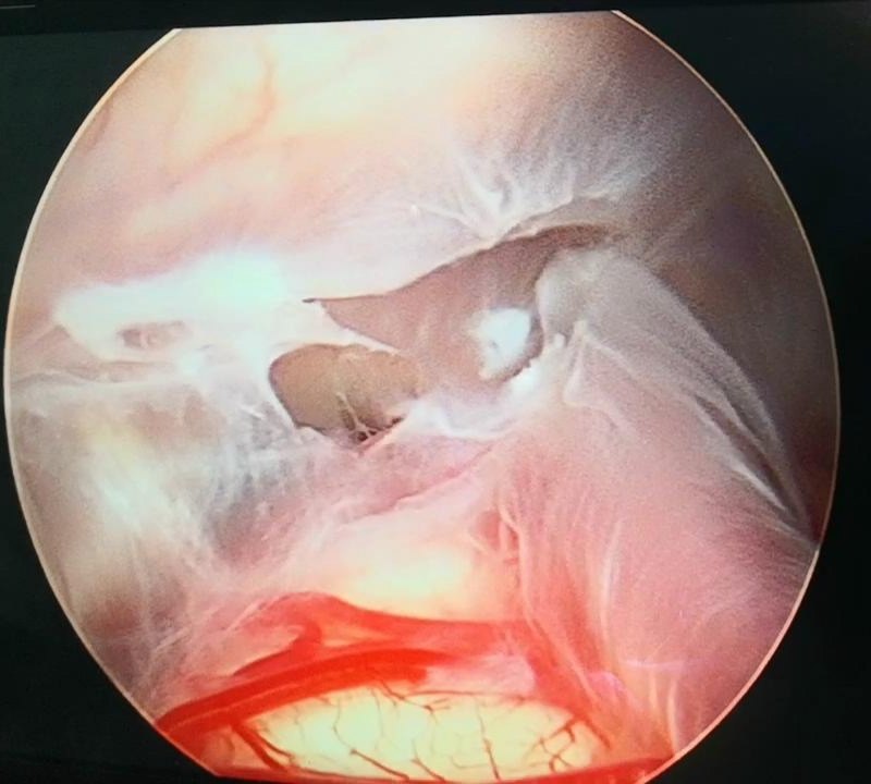 神经内镜下蛛网膜囊肿造瘘手术病例分享2例