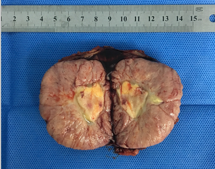 腹腔镜肾上腺转移瘤切除术 - 好大夫在线