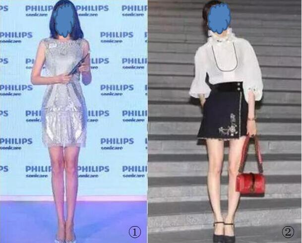 一图教你识别膝关节是内翻 O形腿 还是外翻 X形腿 一图教你识别膝关节是内翻 O形腿 还是外翻 X形腿