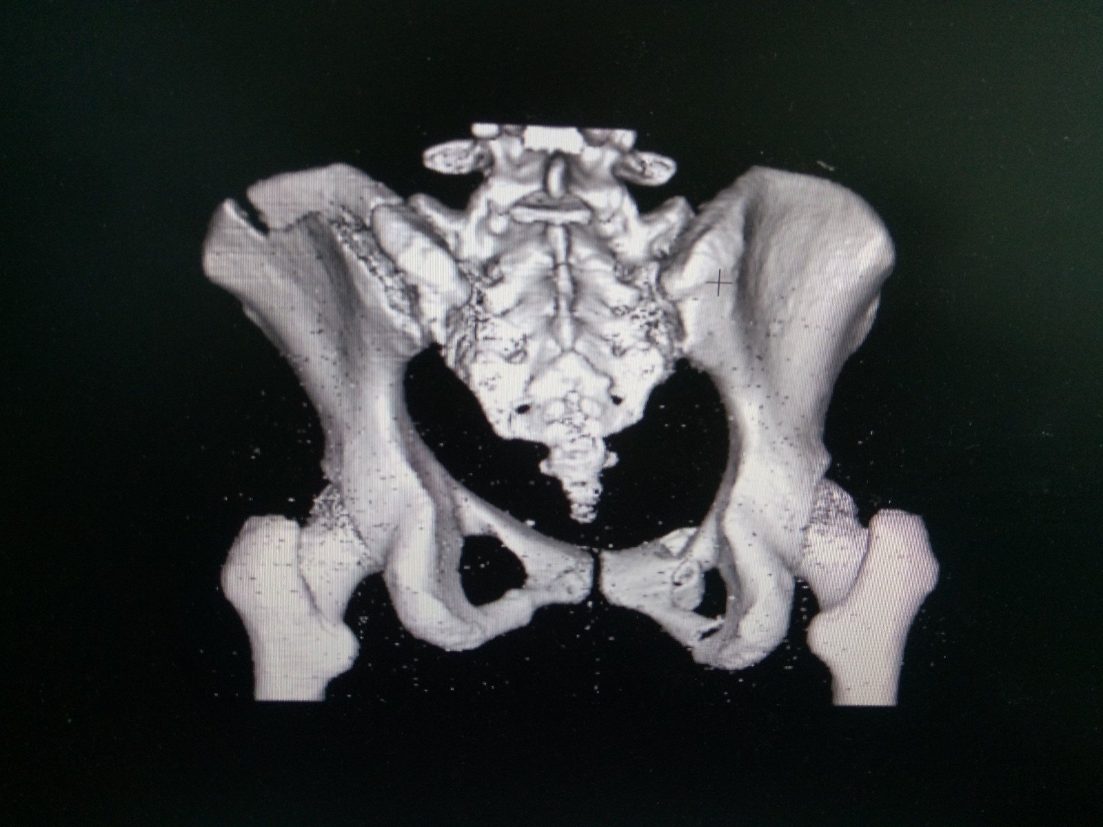 骨盆骨刺图片图片