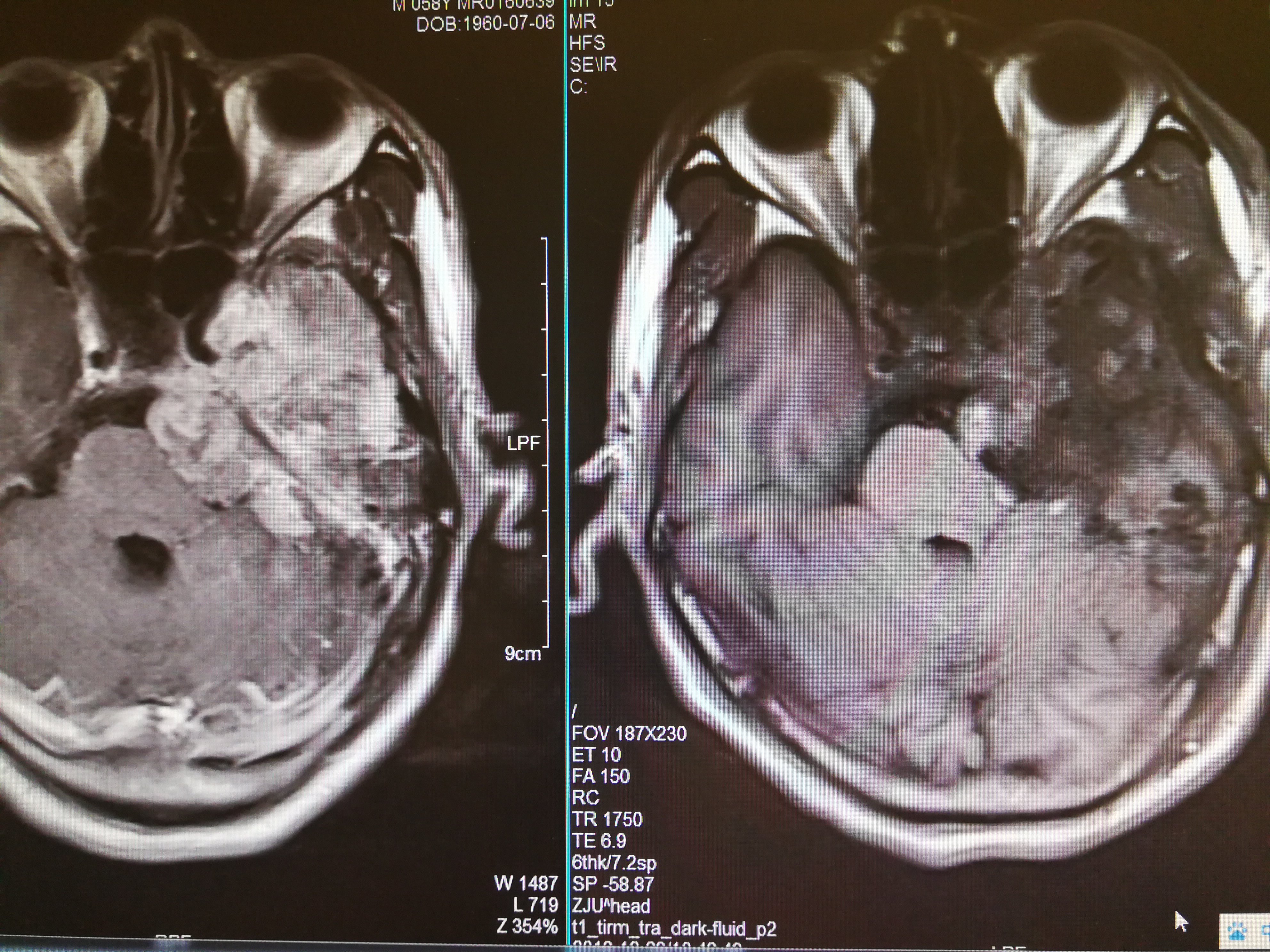 脑膜瘤科普知识介绍(八,中颅底及岩斜区脑膜瘤) - 好大夫在线
