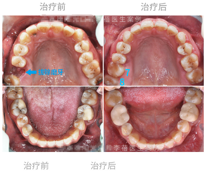 上颚智齿外翻图片图片