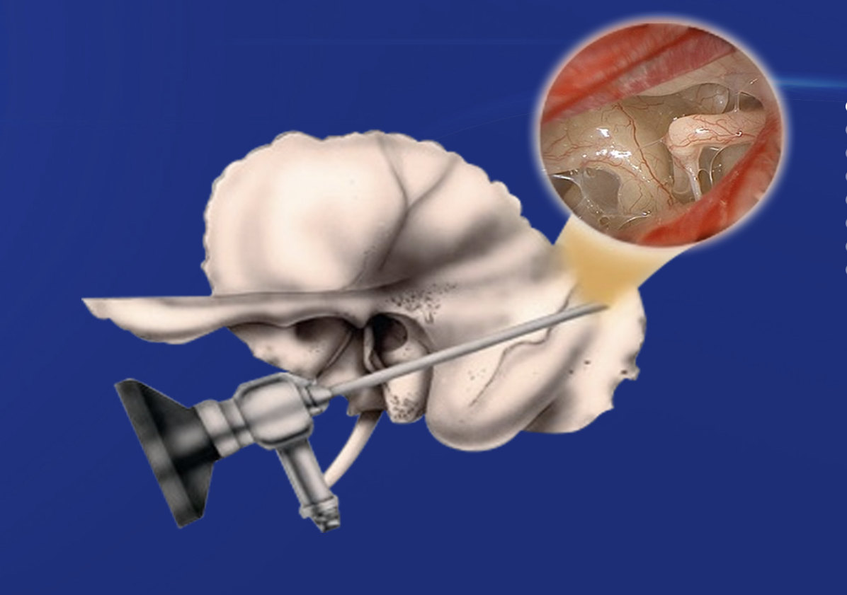 耳內鏡外科技術