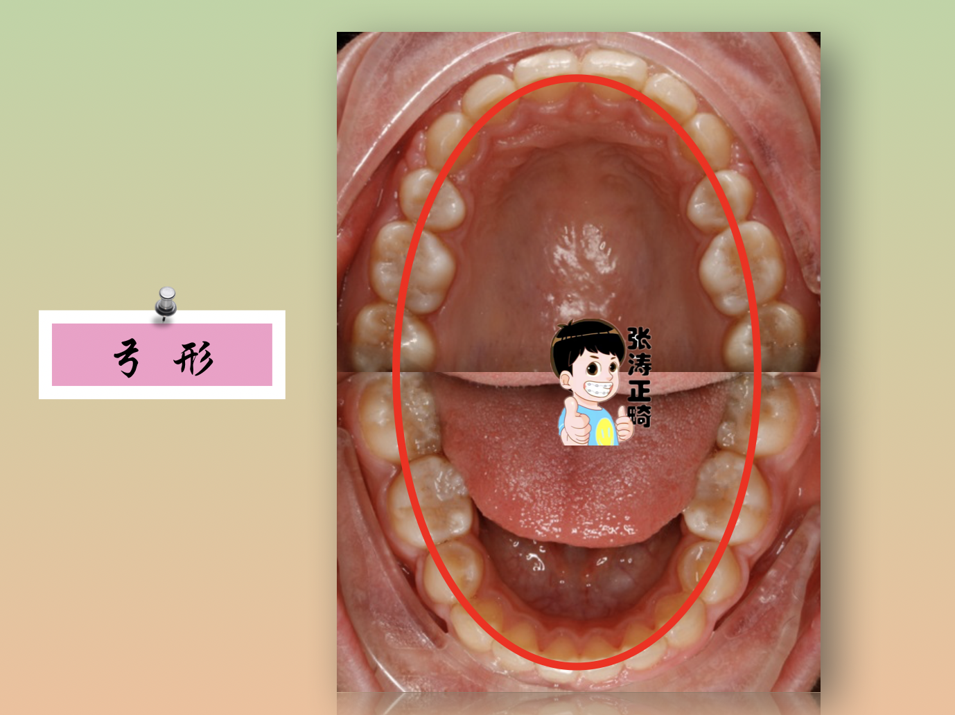 轻度双颌前突图片图片