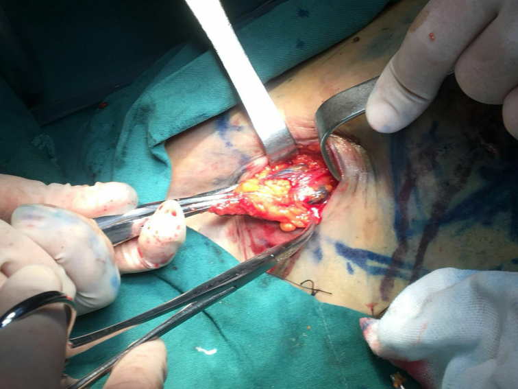 乳腺引流手术切口图片图片