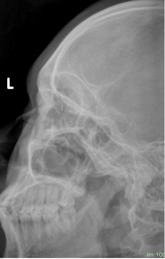 鼻骨骨折是拍x线平片还是ct呢 鼻骨骨折 鼻骨骨折检查 鼻骨骨折是拍x线平片还是ct呢 鼻骨骨折 鼻骨骨折检查