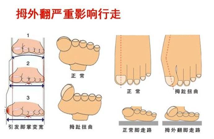 拇外翻怎么治疗 拇外翻 疾病介绍 病因 治疗方法 手术 症状