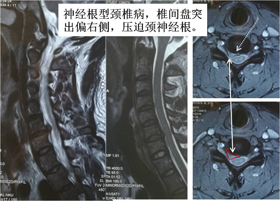 小科普 颈椎病的症状 检查及治疗 颈椎病 症状 检查 治疗方法 手术