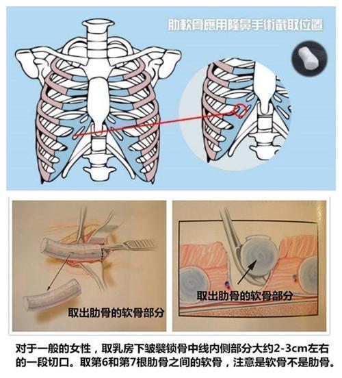 鼻综合手术 取肋软骨对身体有伤害吗 隆鼻 隆鼻