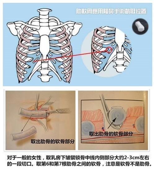 鼻综合手术 取肋软骨对身体有伤害吗 隆鼻 隆鼻 鼻综合手术 取肋软骨对身体有伤害吗 隆鼻 隆鼻