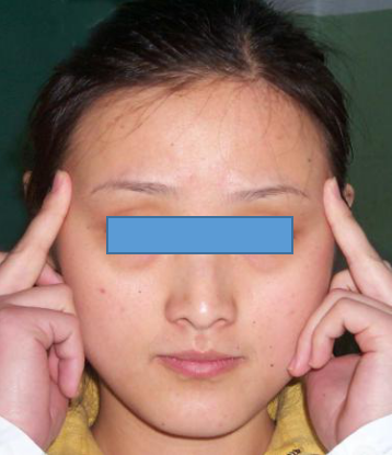 咬肌2)主要闭口肌的位置:咬肌,颞肌前中后束,二腹肌等颞颌关节的部位1