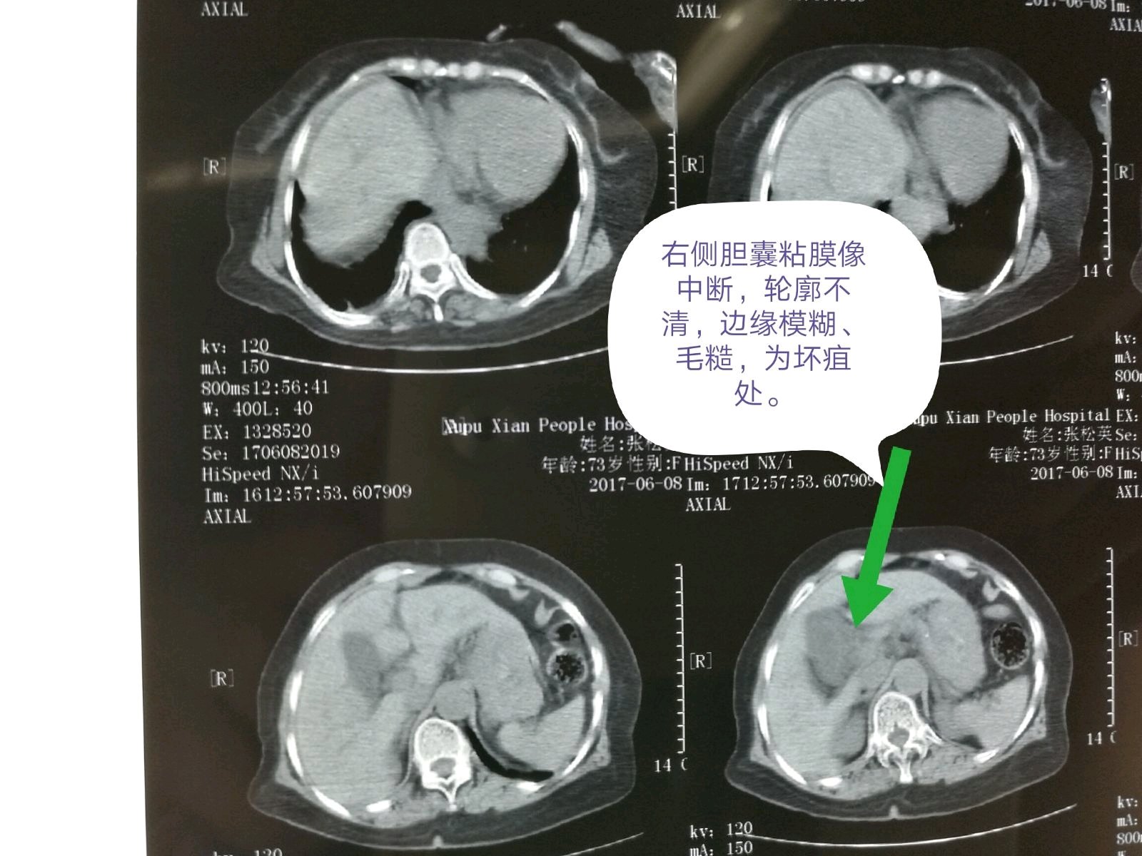 ct:腹腔積液,膽囊炎,胰腺炎.