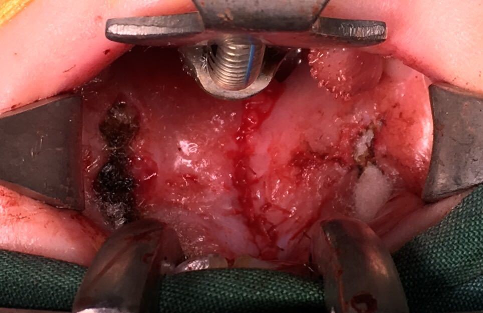 腭裂小舌分开手术后图图片