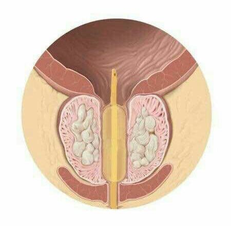 前列腺增生患者的福音小小水囊显神威