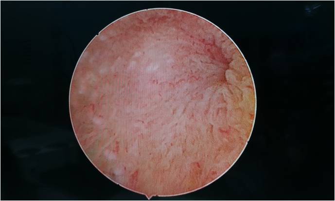 腹腔鏡微創保膽取石術(術者:孫興)_腹腔鏡手術_治療方式_治療介紹