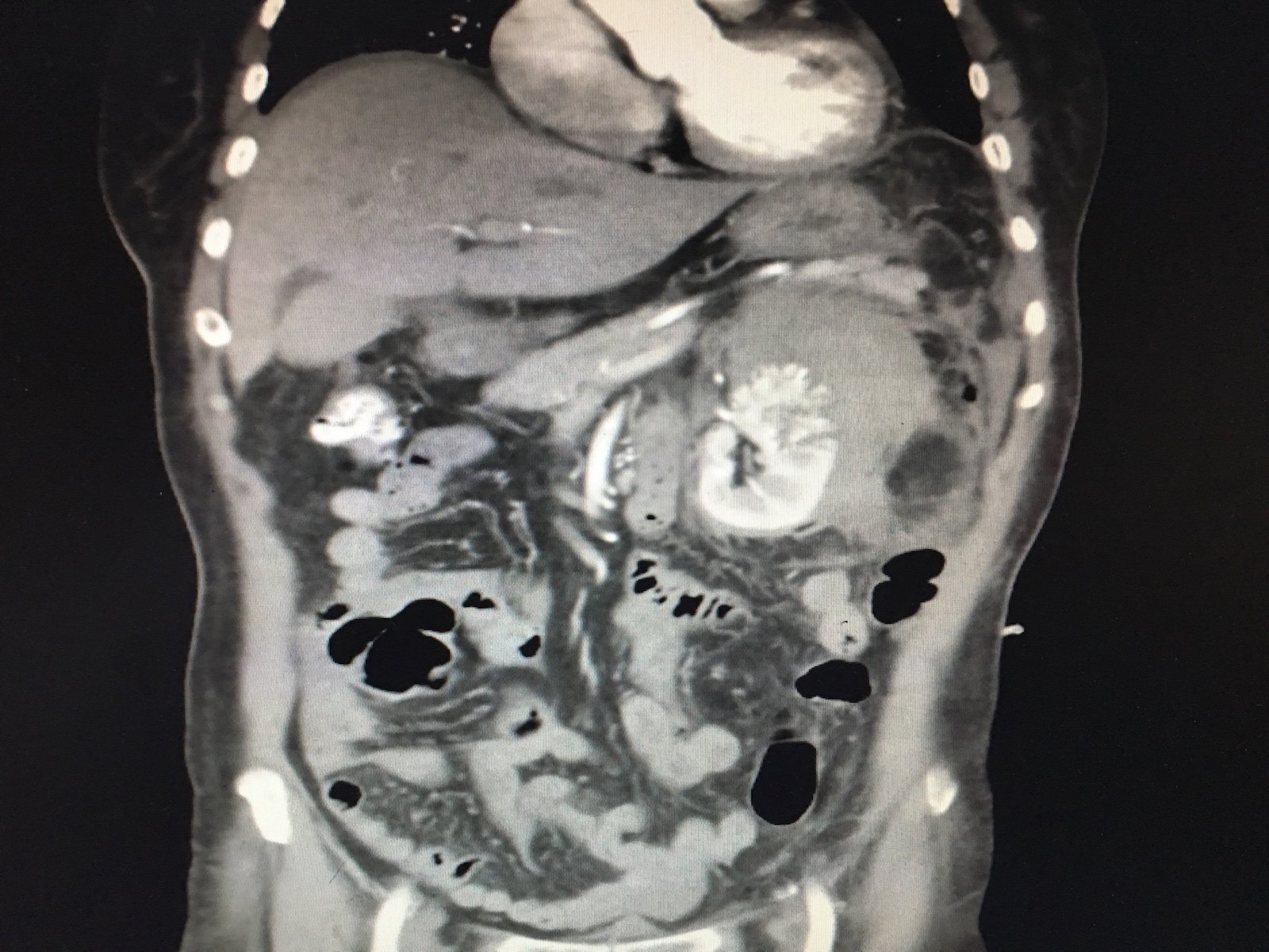 巨大左肾错构瘤自发性破裂出血1例