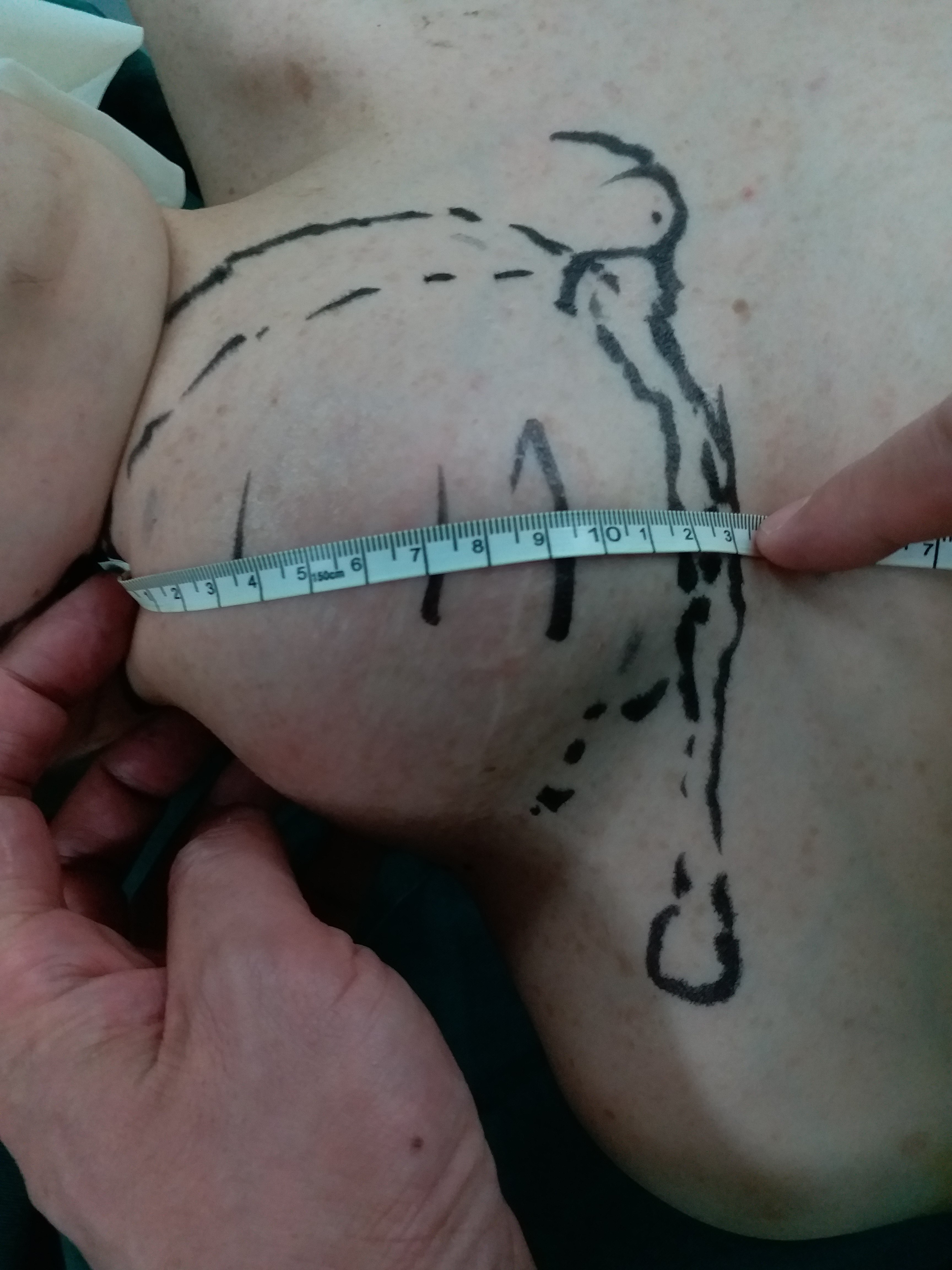 一例巨大颈肩部恶性神经鞘膜瘤在江苏省人民医院骨与软组织肿瘤