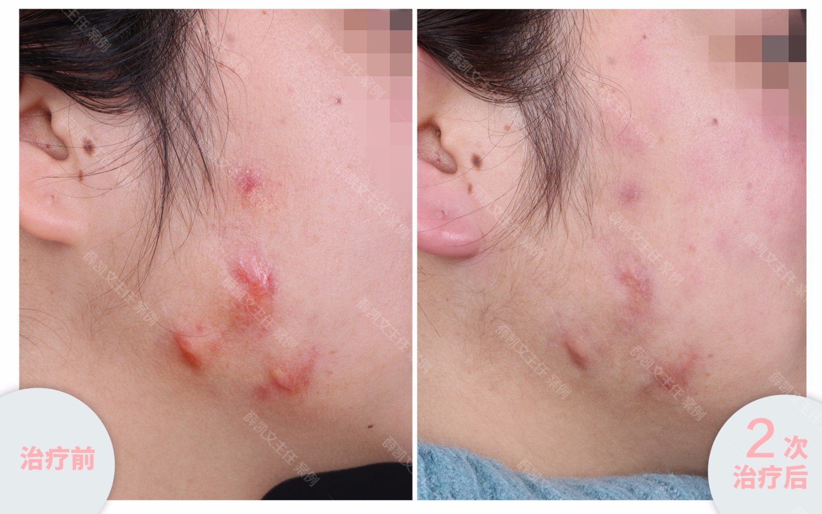 一针肉毒素,长出了下颌疤痕疙瘩