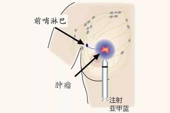 腋窝淋巴结分布图片图片