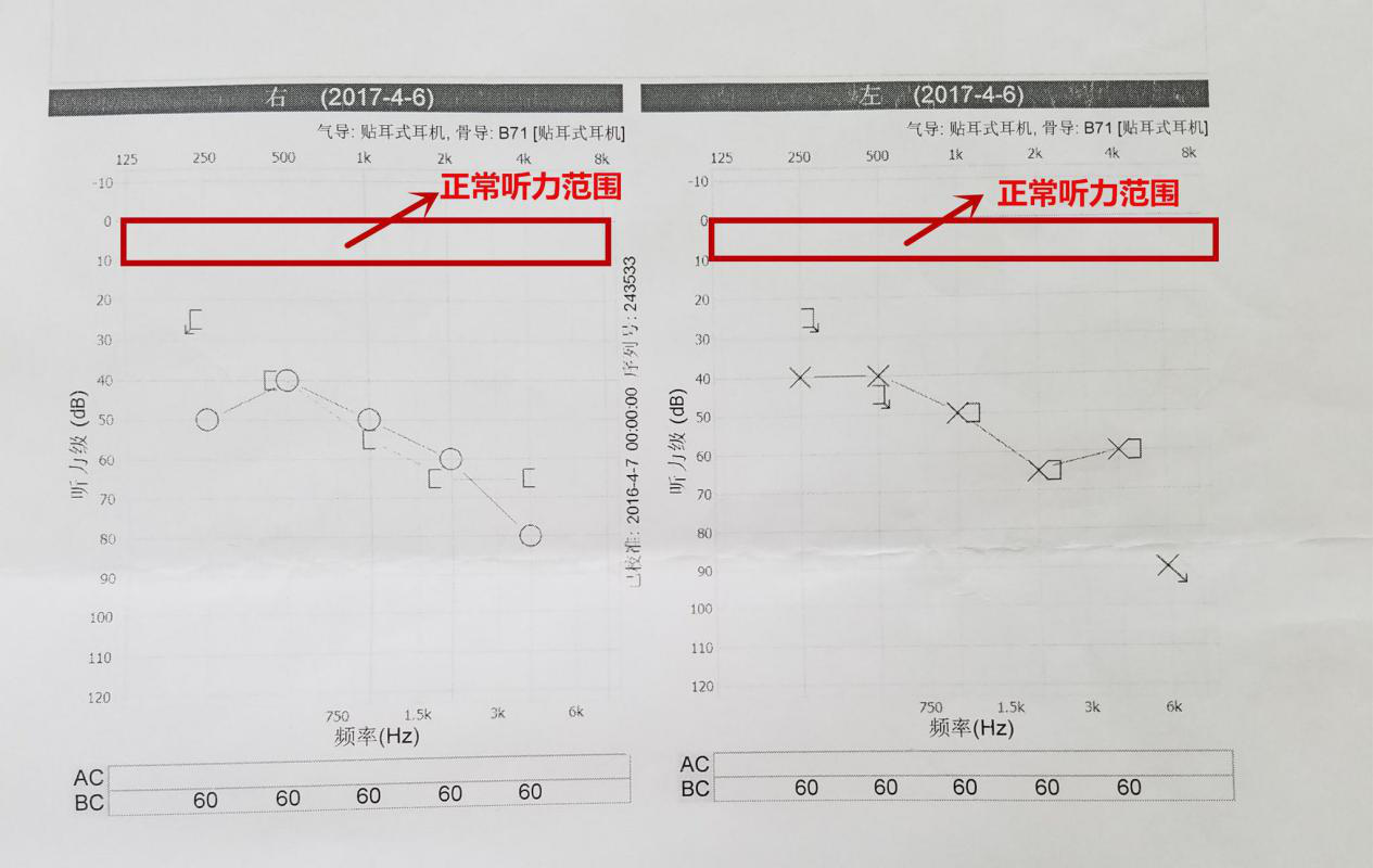 治疗顽固性耳鸣脑鸣微血管减压