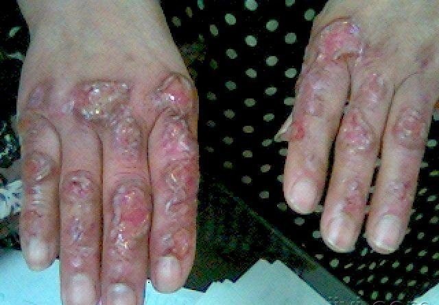 胡刚医生特色治疗之1——皮肤慢性溃疡的系统性治疗 - 好大夫在线