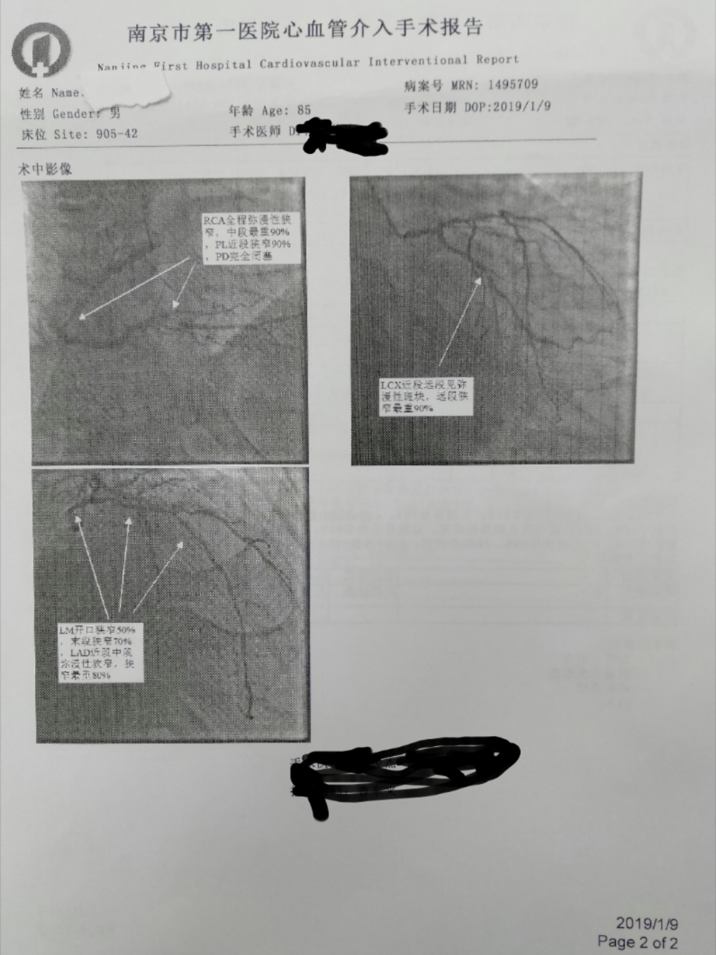 86岁老爷子行冠状动脉搭桥术