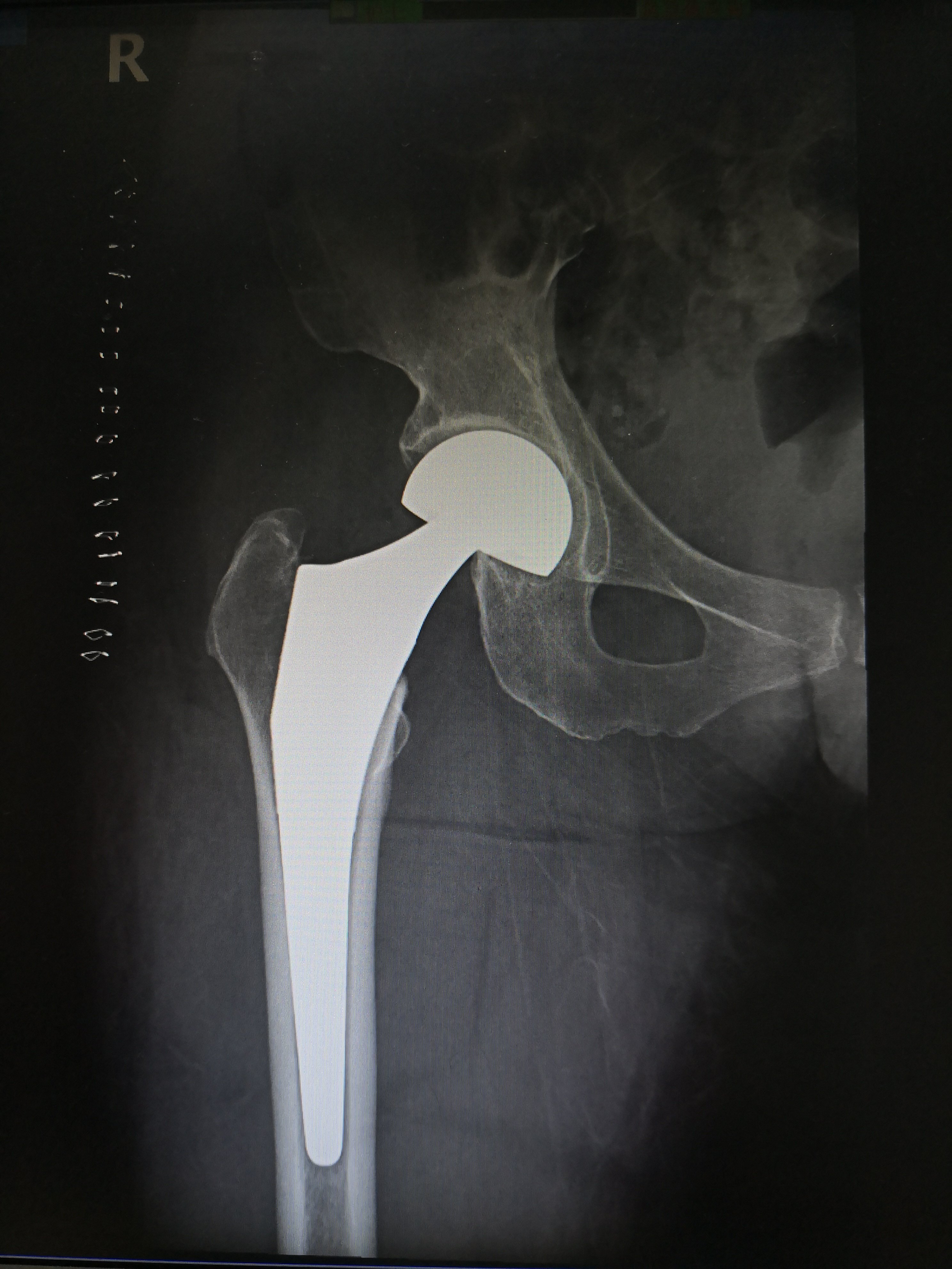 术后人工半髋关节术前股骨颈骨折