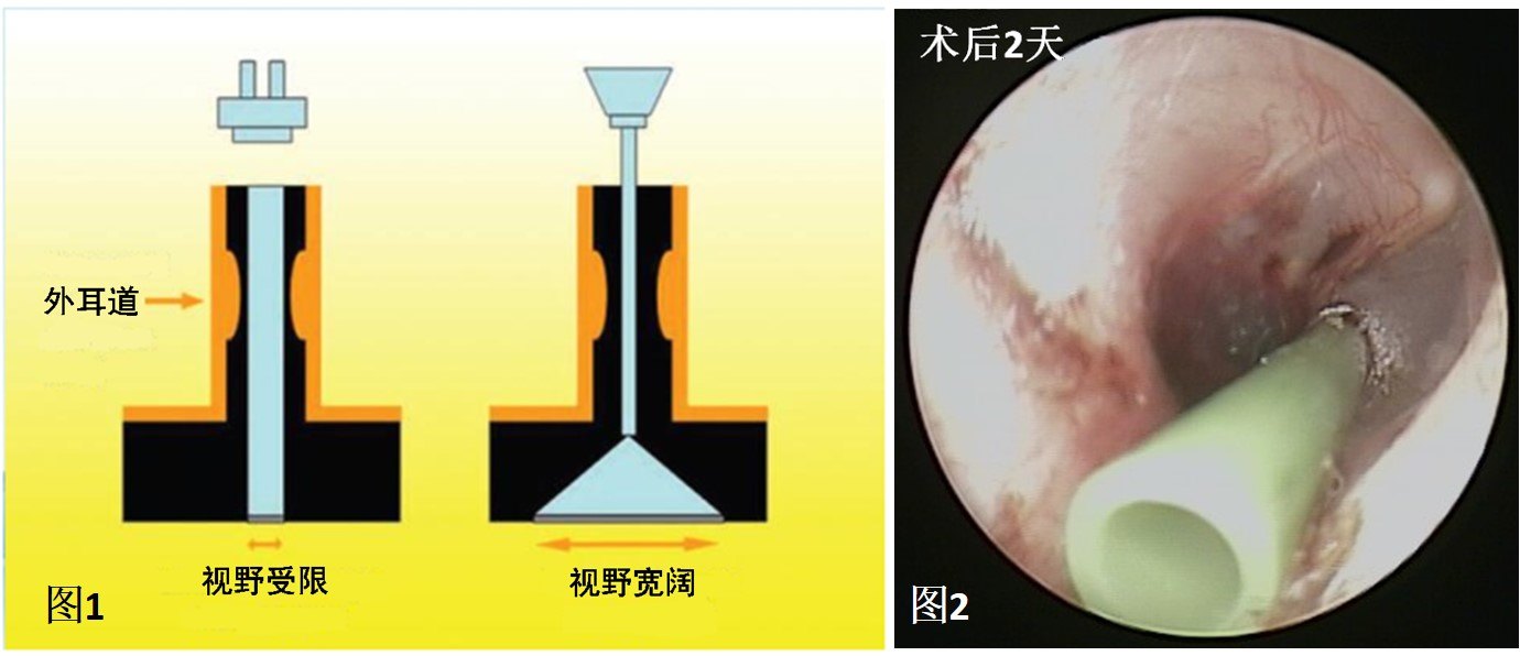 耳朵积液穿刺手术图解图片