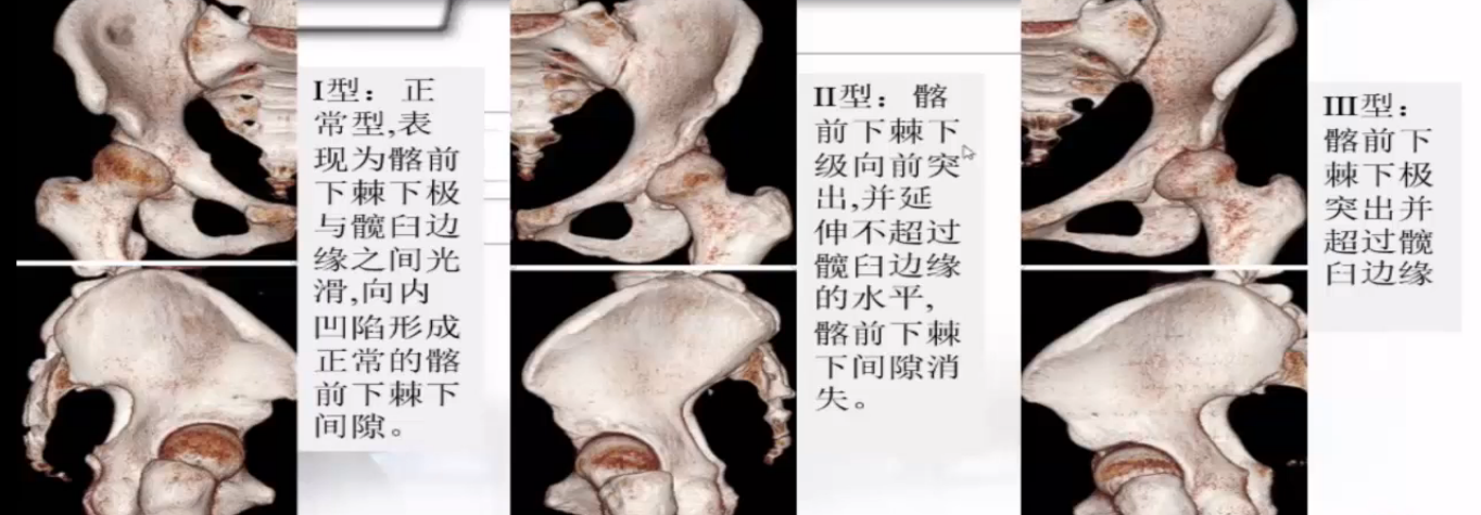 髂前下棘撞击征的诊断和治疗——广东省中医院杨伟铭 - 好大夫在线
