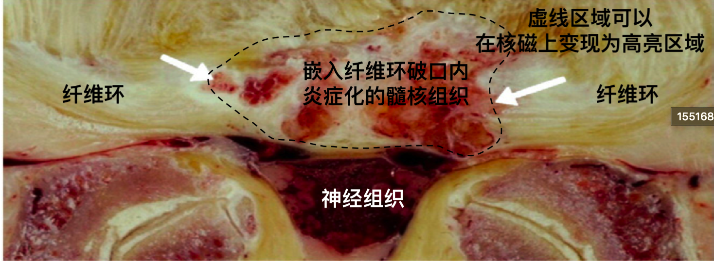 白色箭头所指的红色病灶,是椎间盘的纤维环破裂后形成的,正是这样的