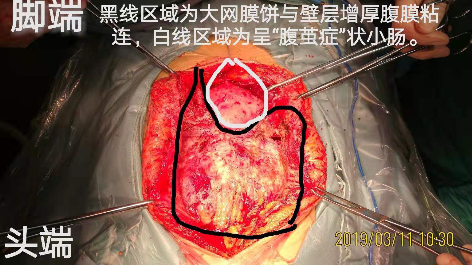 术中所见:大网膜饼与壁层腹膜紧密粘连,壁层腹膜增厚明显,结肠下区