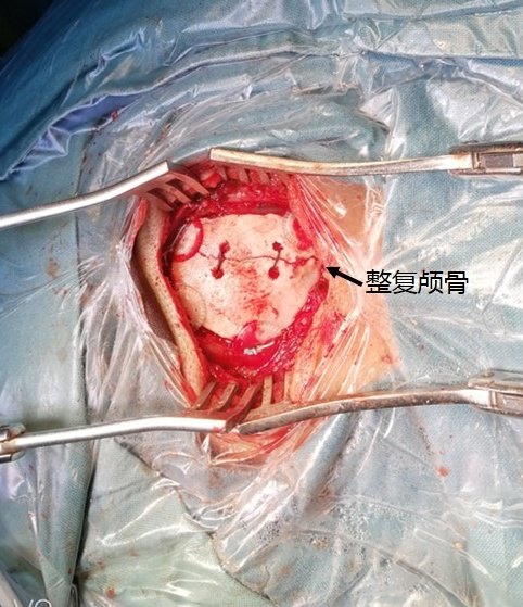 5米高的阁楼摔下,伤后有头痛,来医院检查提示右侧枕骨骨折 后颅窝硬膜