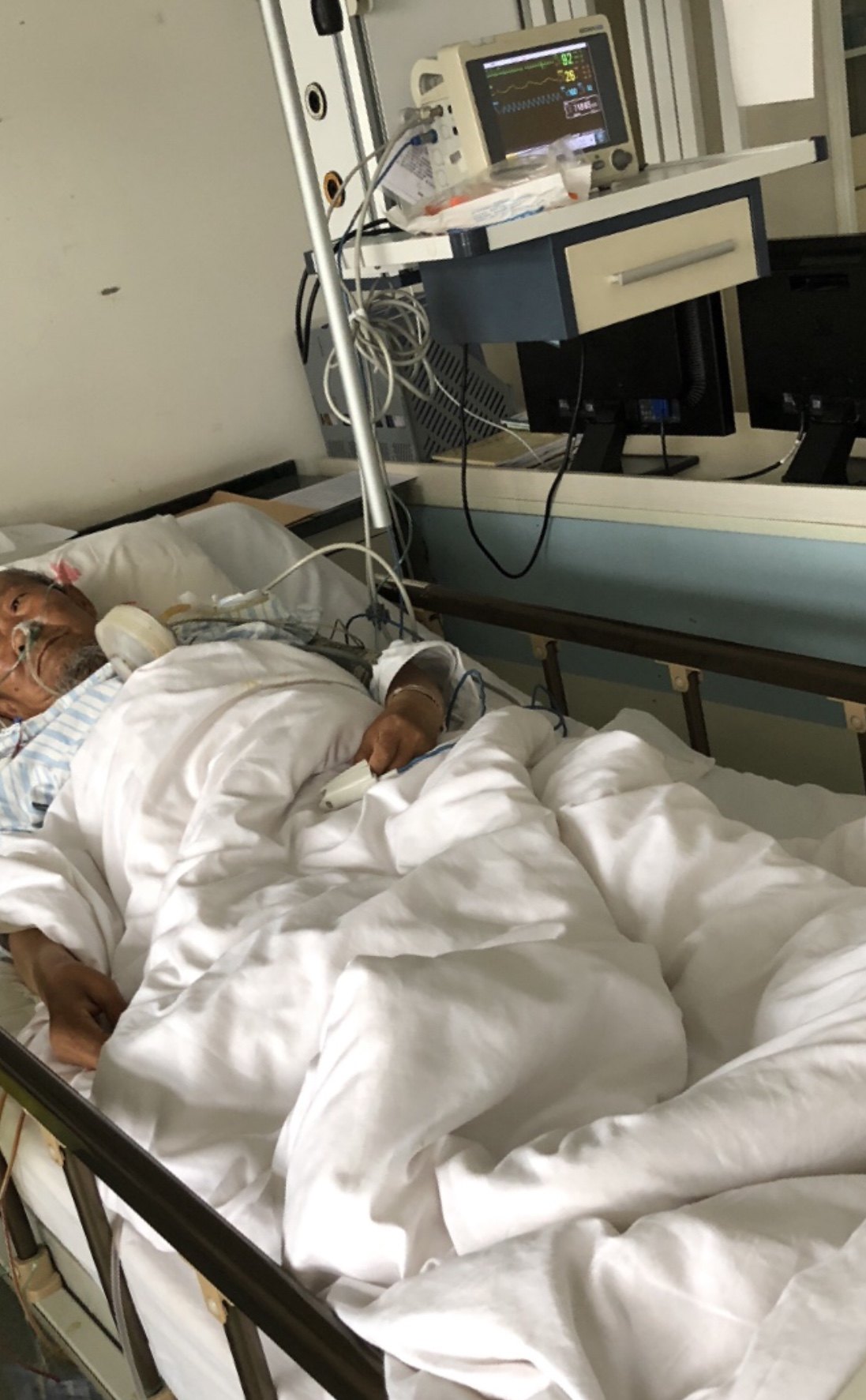 晚期巨块肝癌手术:b级肝功门静脉肝中肝右静脉癌栓右半肝切除 - 好