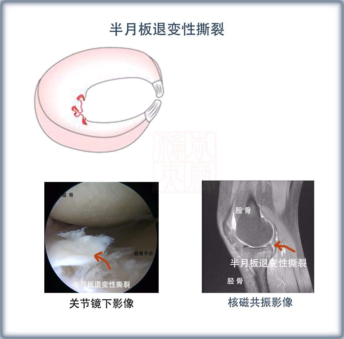 半月板損傷的最好治療方法哪種修復治療方法好效果如何含錄像