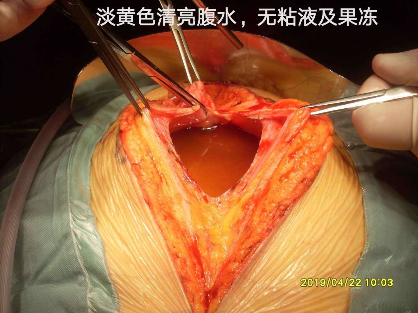 病例48--女性高腹压pmp导致呼吸困难 - 好大夫在线