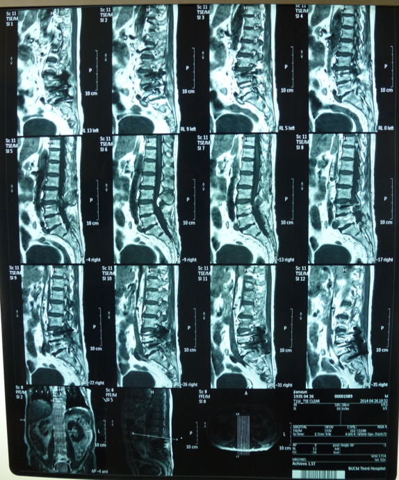 查体:腰椎僵硬,腰肌紧张,l3棘突,l34两侧,环跳穴压痛治疗:选取上述四