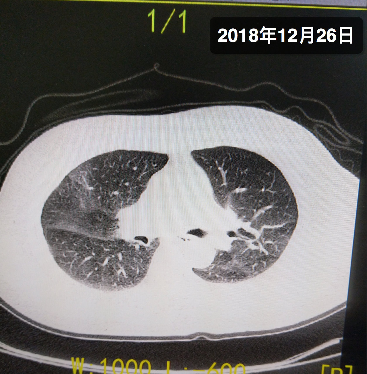 间质性肺炎属于大病吗 间质性肺炎ct影像表现