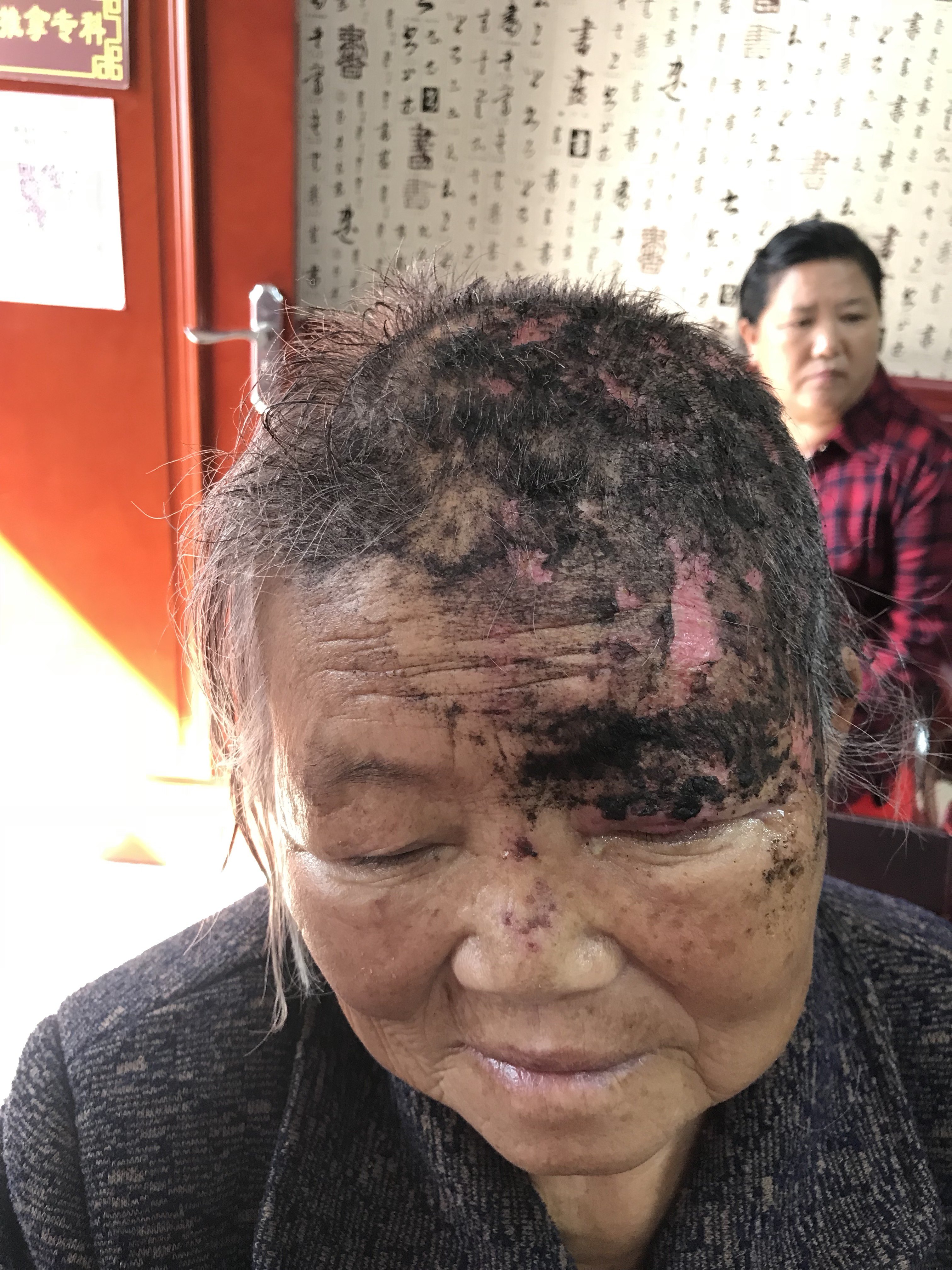 中药外敷在带状疱疹中的应用!(真实病例愈合过程) - 好大夫在线