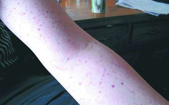 单纯性紫癜_疾病介绍_治疗方法 - 好大夫在线