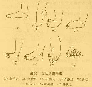 先天性马蹄内翻足_治疗方法_治疗方式 - 好大夫在线