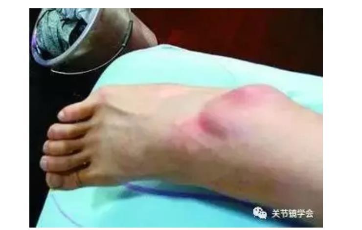 为什么有人 崴脚 了还要做手术 踝部扭伤 踝部扭伤 为什么有人 崴脚 了还要做手术 踝部扭伤 踝部扭伤
