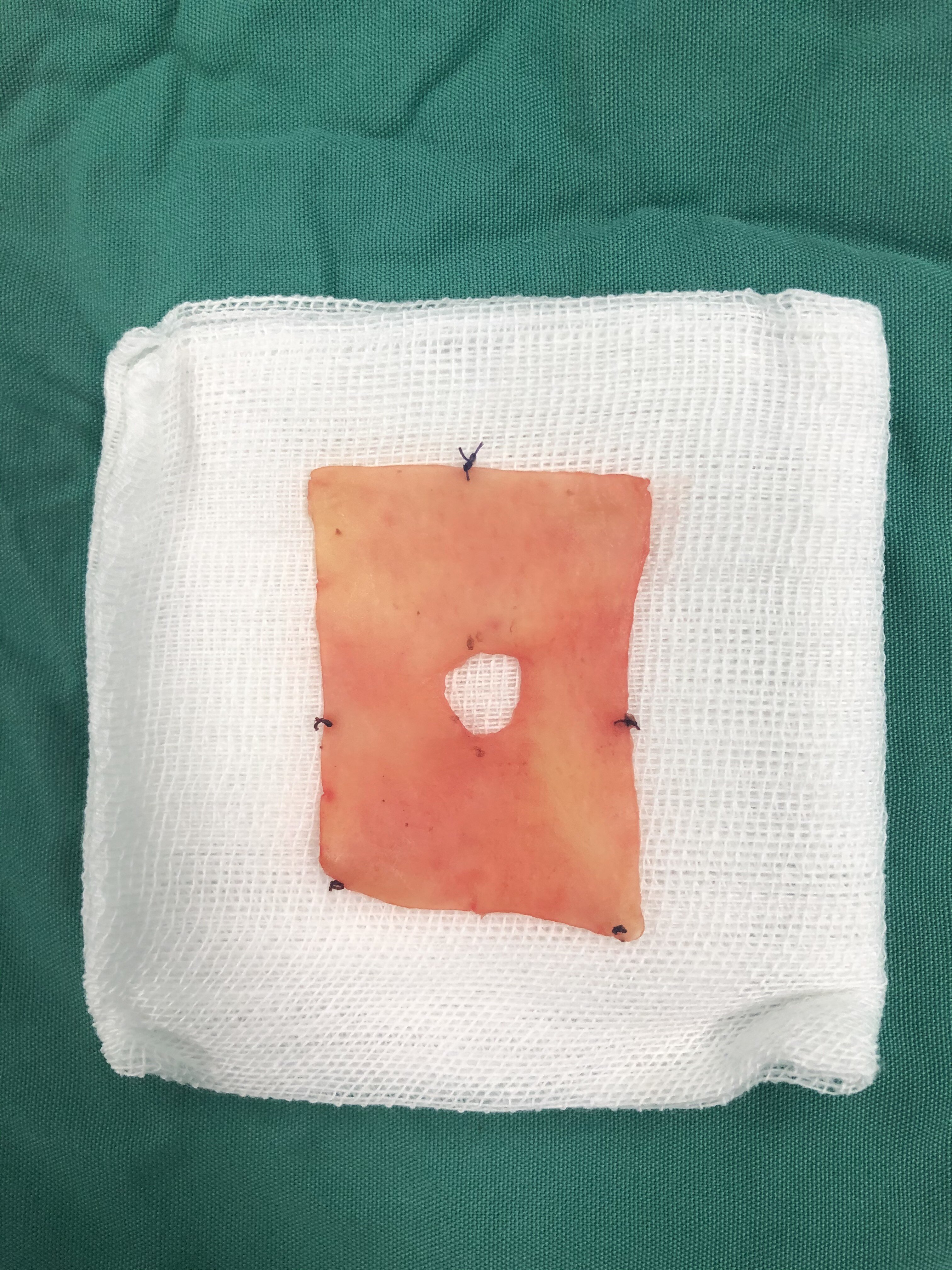 手术工作日志25:阴茎增粗 早泄治疗手术后生物补片取出术